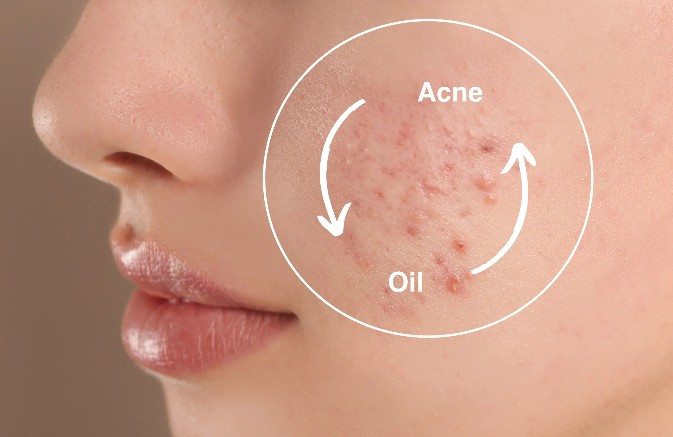 Face Cream for Acne Prone Skin - Image 2
